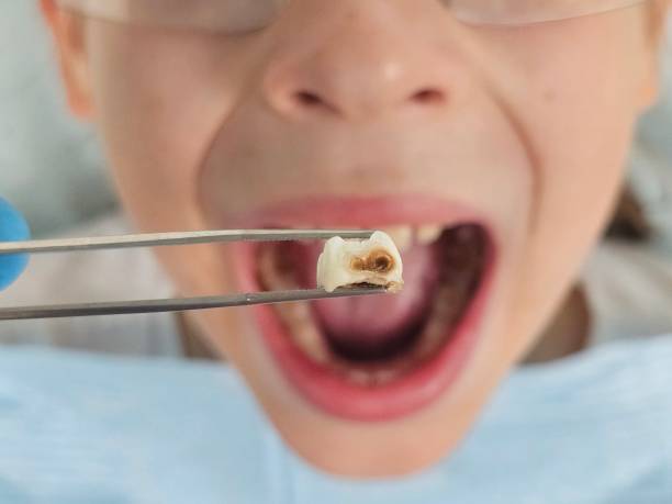 Best Root Canal Emergency Dentist  in Atchison, KS